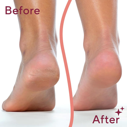PediShine™ - Pedicure Electric Foot Callus Remover